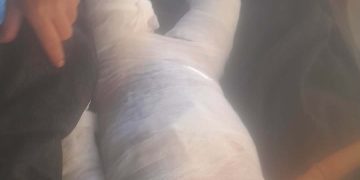 जलेर घाइते बालिकाको भारतमा उपचार, आर्थिक सहयोगको अपिल